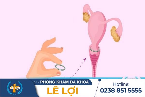 Đặt vòng tránh thai và những điều cần lưu ý